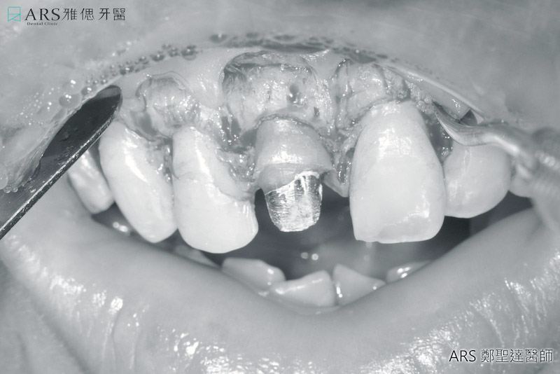 傳統牙冠增長術
