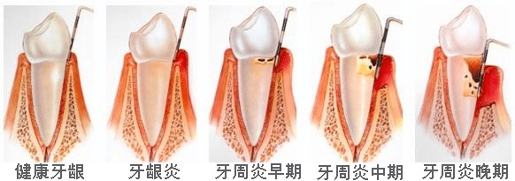 牙周病嚴重程度示意圖