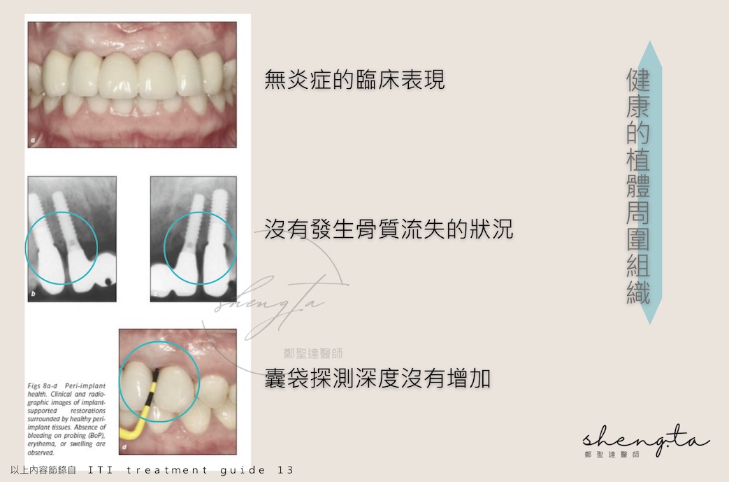 健康的植體周圍組織狀態:無炎症表現與骨質流失狀況,囊袋探測深度沒有增加