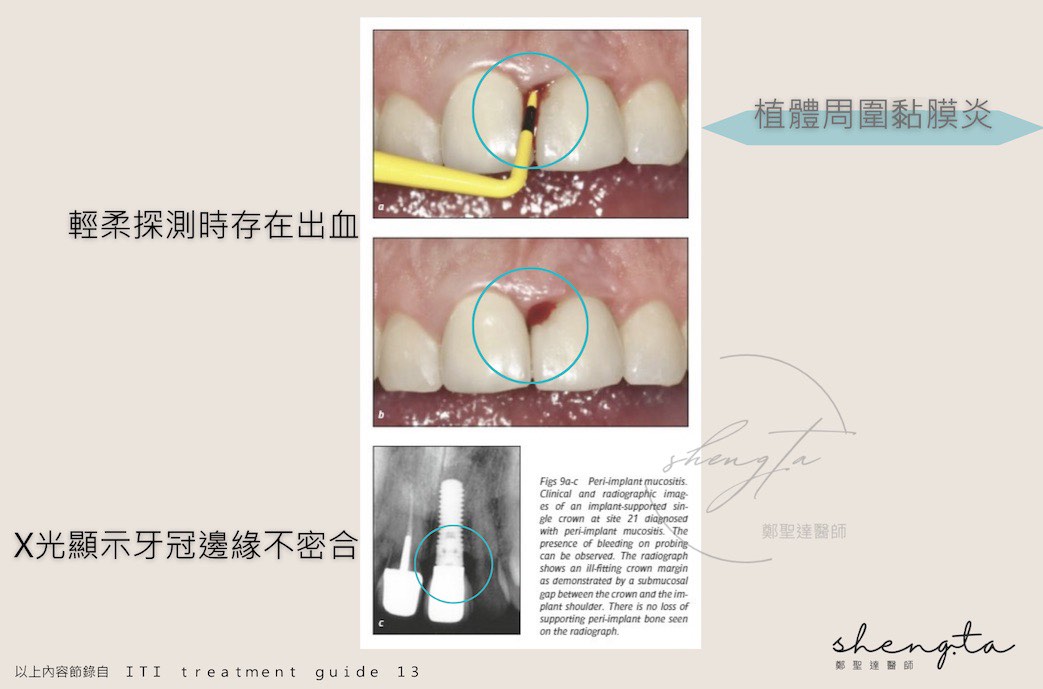 植體周圍黏膜炎病例狀態:輕柔探測時存在出血,X光顯示牙冠邊緣不密合