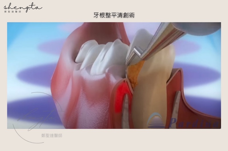 微創牙根整平術示意圖