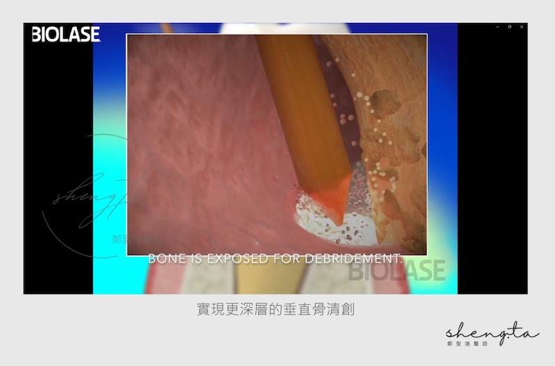 水雷射光纖探頭清創示意圖