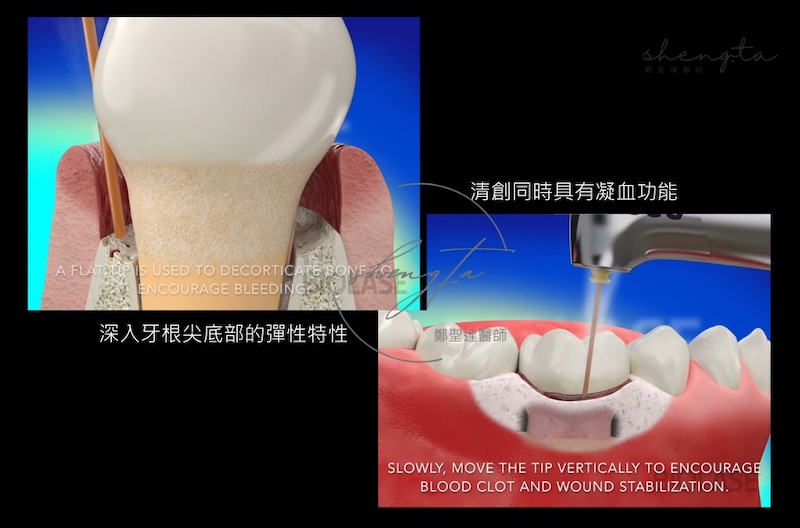 水雷射探頭清創及凝血示意圖