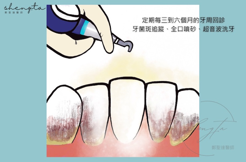 牙周噴砂/牙周回診輔助療程