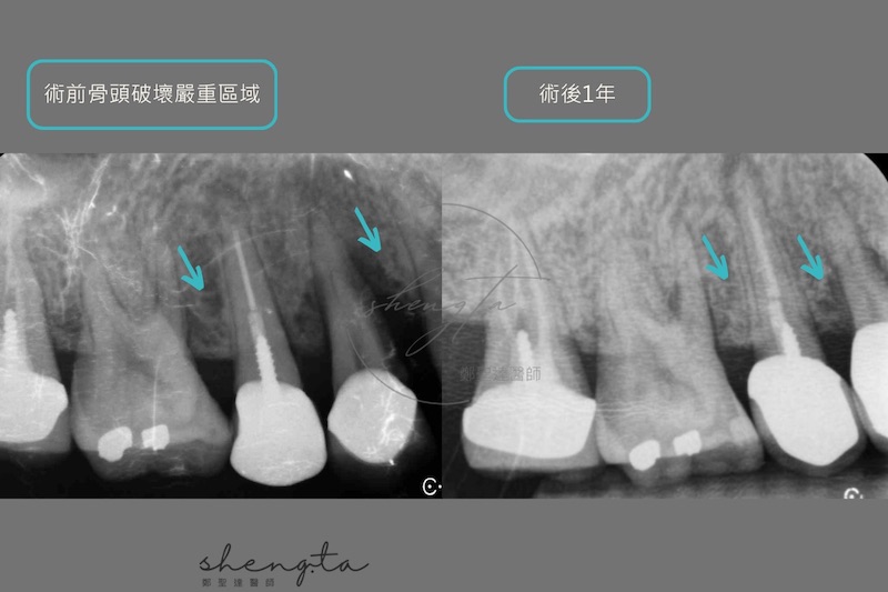 右上第一二小臼齒及第一大臼齒牙周再生手術一年後與初診的根尖X光片對比,術前嚴重破壞的牙周組織及齒槽骨已恢復達90%以上