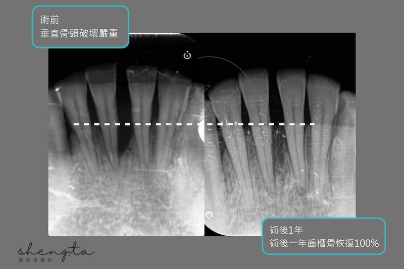 右下門牙牙周再生手術一年後與初診的根尖X光片對比,術前嚴重破壞的牙周組織及齒槽骨恢復良好