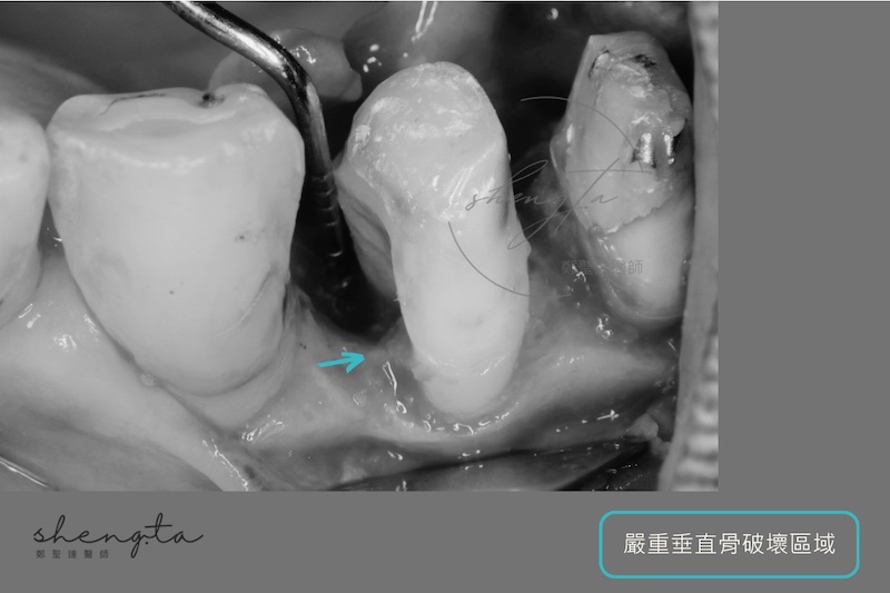 牙周再生手術前,右上第一二小臼齒嚴重垂直骨破壞區域