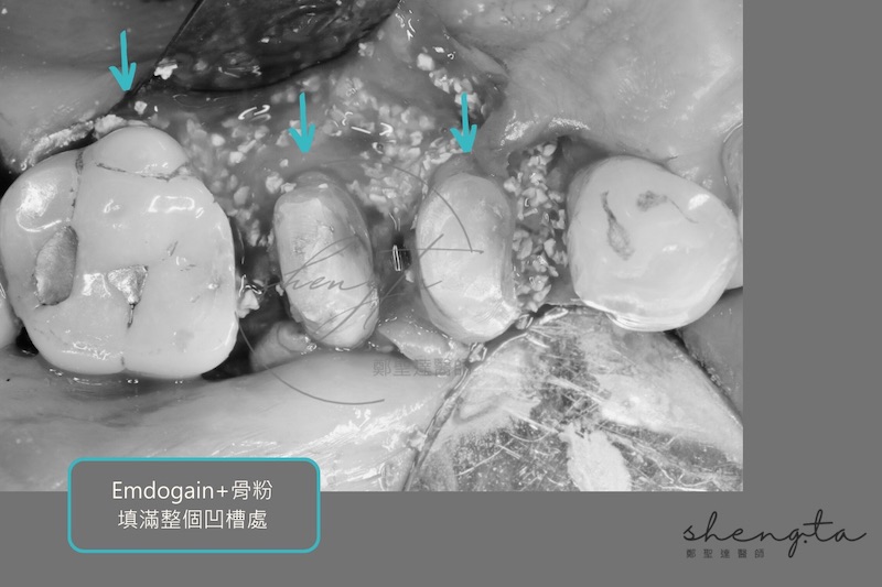 右上第一二小臼齒及第一大臼齒齒槽骨嚴重破壞區,將骨粉及再生因子填滿整個凹槽
