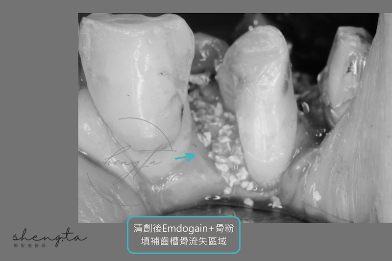 牙周再生手術清創後填入骨粉和再生因子Emdogain,填補齒槽骨流失區域