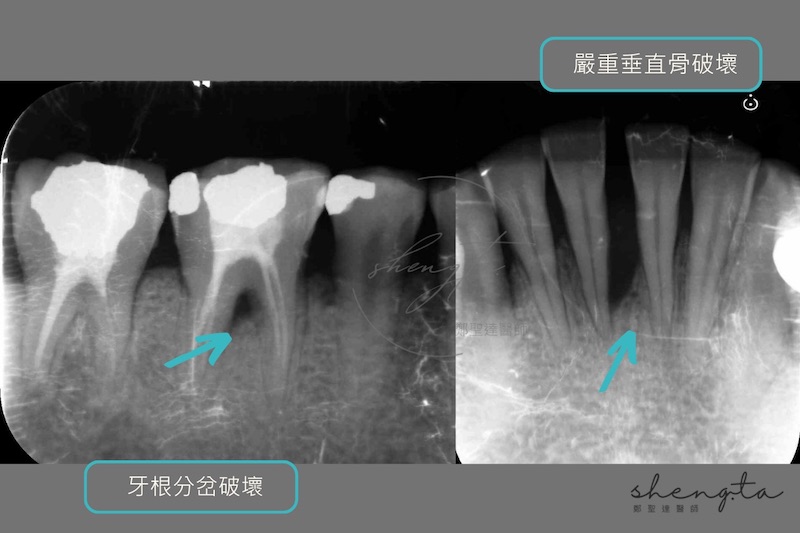 牙周再生手術前,右下臼齒與正中門牙的根尖X光片顯示牙周破壞到牙根分岔處,以及嚴重垂直骨破壞