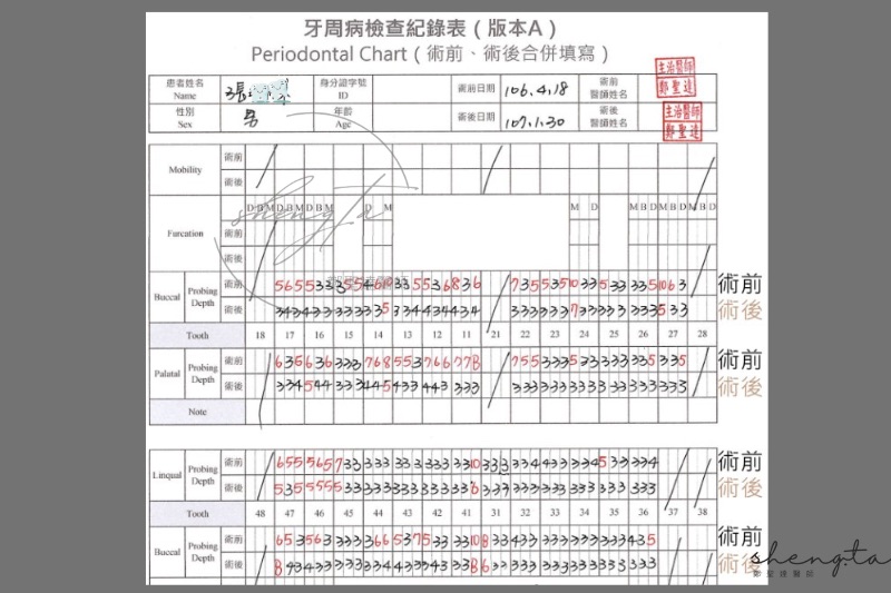 中重度牙周病治療前後的牙周囊袋檢測紀錄表:治療前全口多處牙周囊袋超過5mm,最深的達10mm;牙周治療一年後大多降至3mm