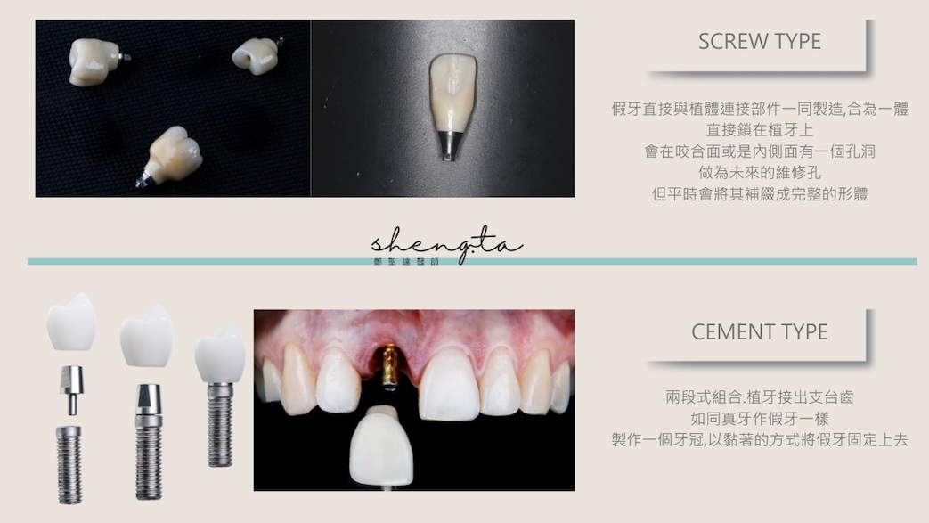 兩種植牙假牙固定方式：螺絲固定（Screw Type）與黏著固定（Cement Type）。螺絲固定的假牙與植體連接部件一體成型，直接鎖在植體上，方便未來維修；黏著固定則是將假牙冠用黏著方式固定在植體接出的支台齒上