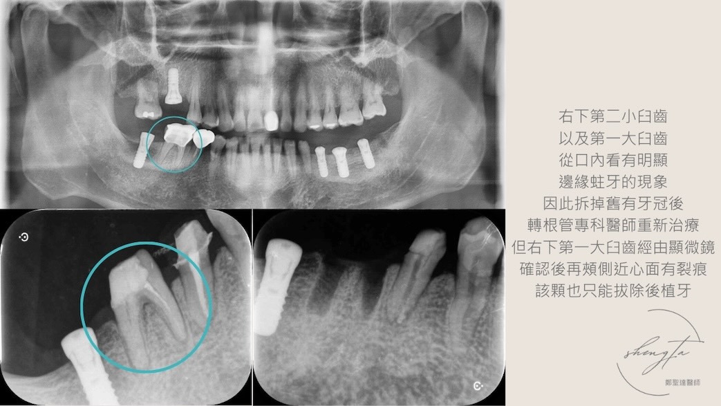 植牙前X光片顯示右下第二小臼齒、第一大臼齒邊緣蛀牙，重新治療後右下第一大臼齒裂痕嚴重只能拔除後植牙