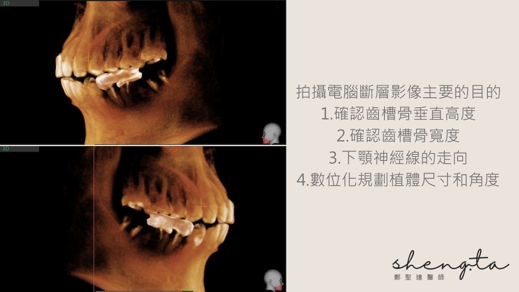 拍攝電腦斷層影像的主要目的：確認齒槽骨垂直高度/寬度、下顎神經線的走向、數位化規劃植體尺寸和角度