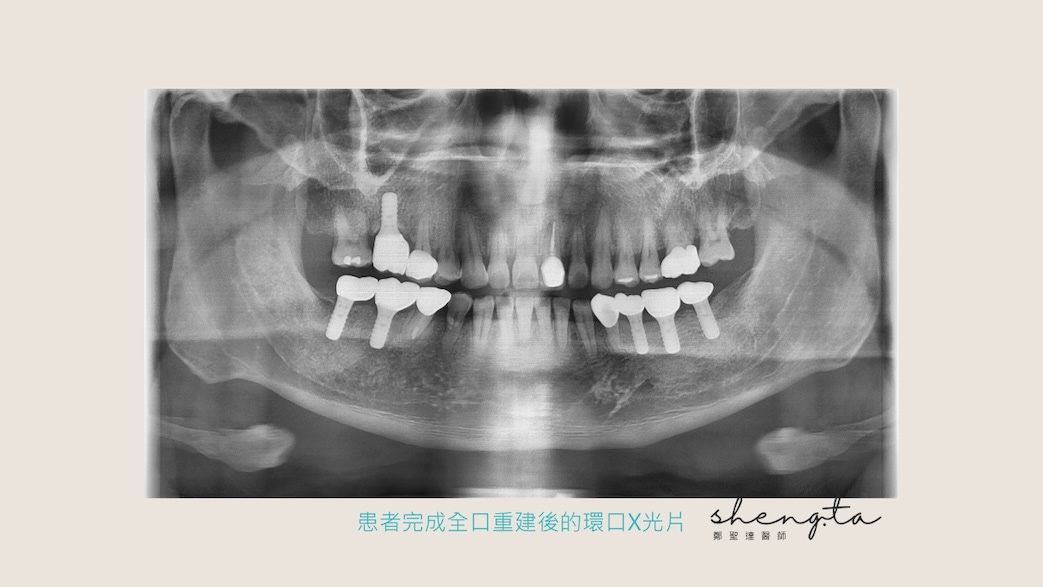 患者完成上下顎植牙後的環口X光片