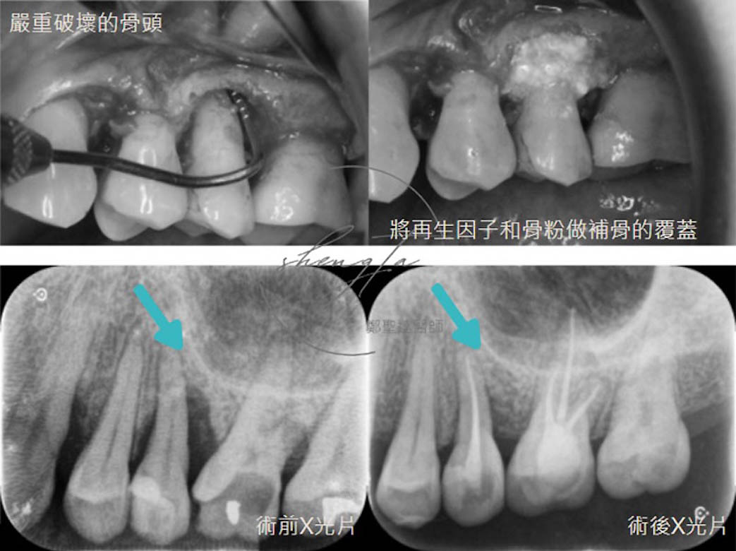 牙周再生手術案例一:手術過程與術前術後對比