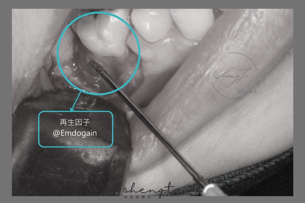 牙周再生手術案例二:手術中使用再生因子Emdogain