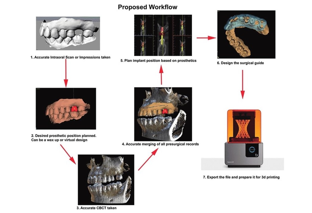 數位植牙的完整工作流程圖，包含口掃、拍攝CBCT、資料合併、假牙與植體規劃、導引板設計及3D列印